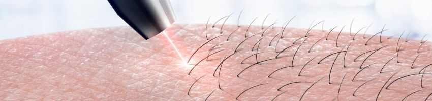 An image of a laser light destroying hair follicles.