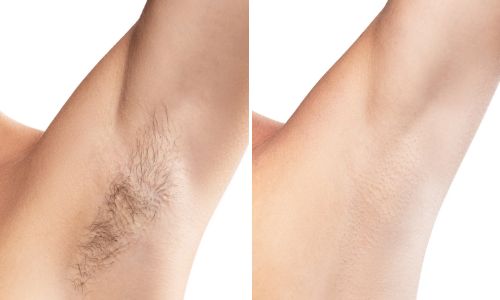 Laser Hair Removal Results (3) Laser Hair Removal Results