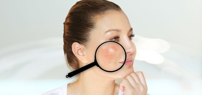 The woman has rosacea on her cheeks.