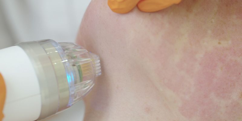 A woman having a lip lightening treatment