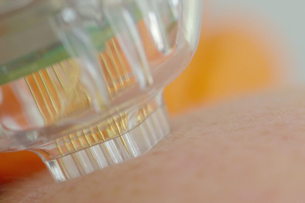 A skin that has cellulite undergoes microneedling.