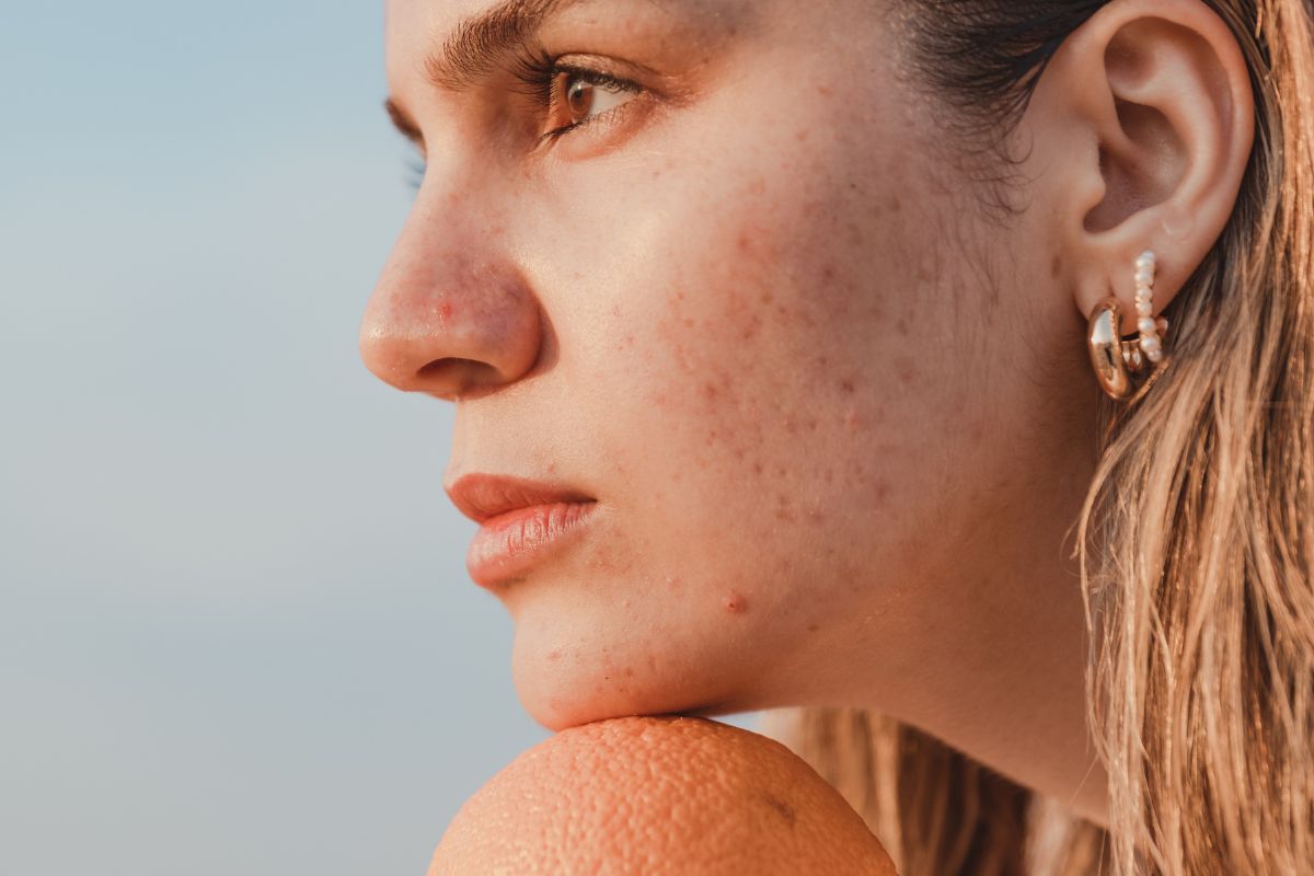 How to Fix Acne Scars and Holes on Face: Science-Backed Tips