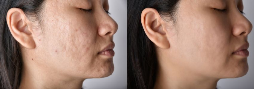 The woman's hole in face is lessen because she undergoes facial treatment.