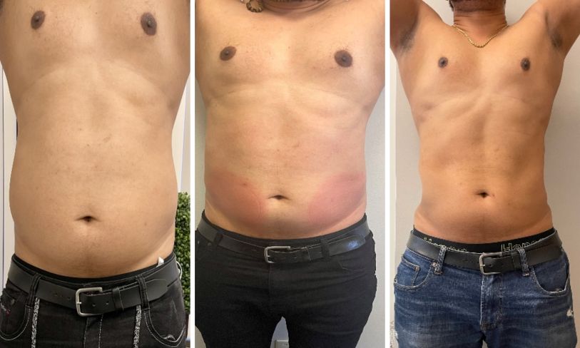 cryo-fat-freeze-after (1) Cryo fat freeze before and after.