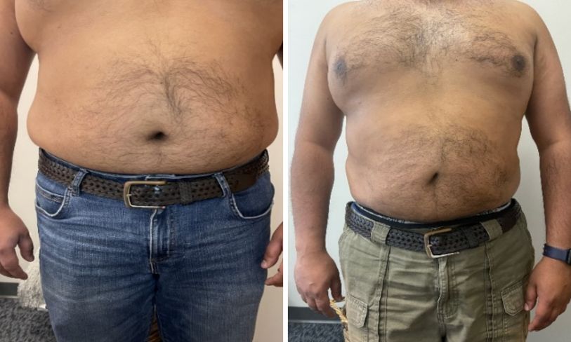 cryo-fat-freeze-after (2) Cryo fat freeze before and after.