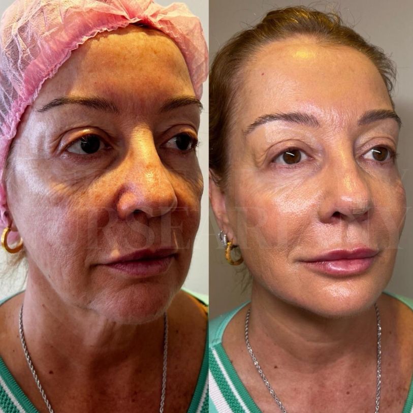 Facelift treatment before and after.