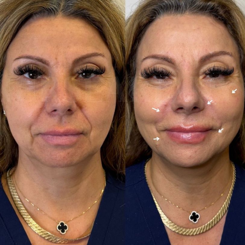 Facelift treatment before and after.