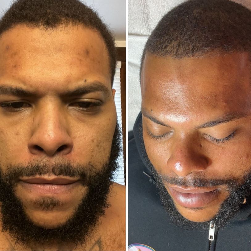 hydrafacial (1) Hydra facial treatment before and after.