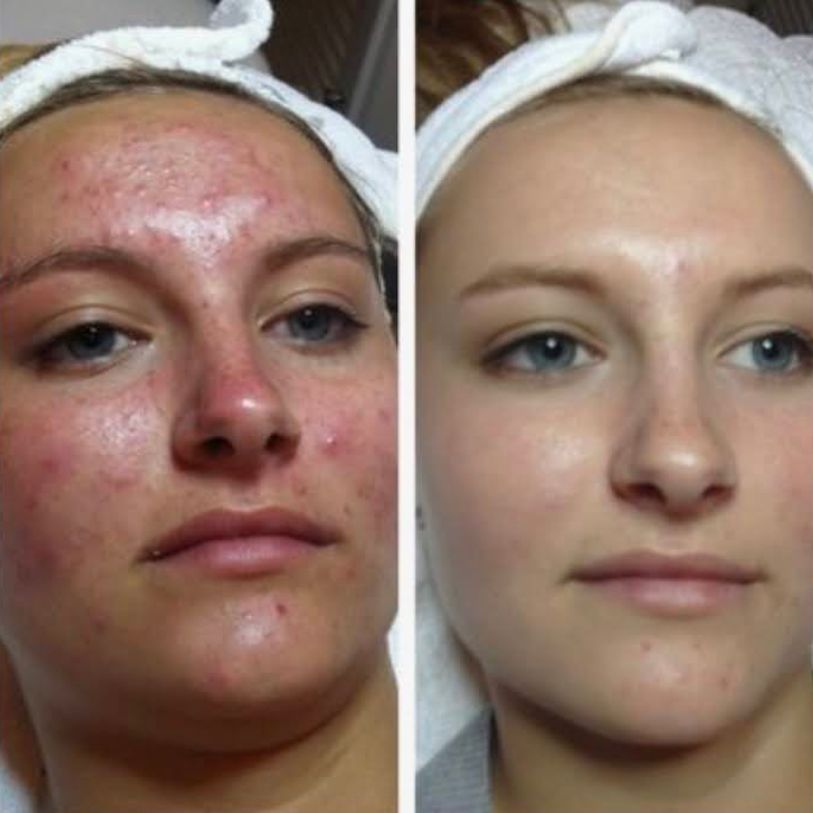 hydrafacial (2) Hydra facial treatment before and after.