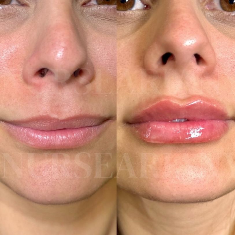 Lip filler treatment before and after.