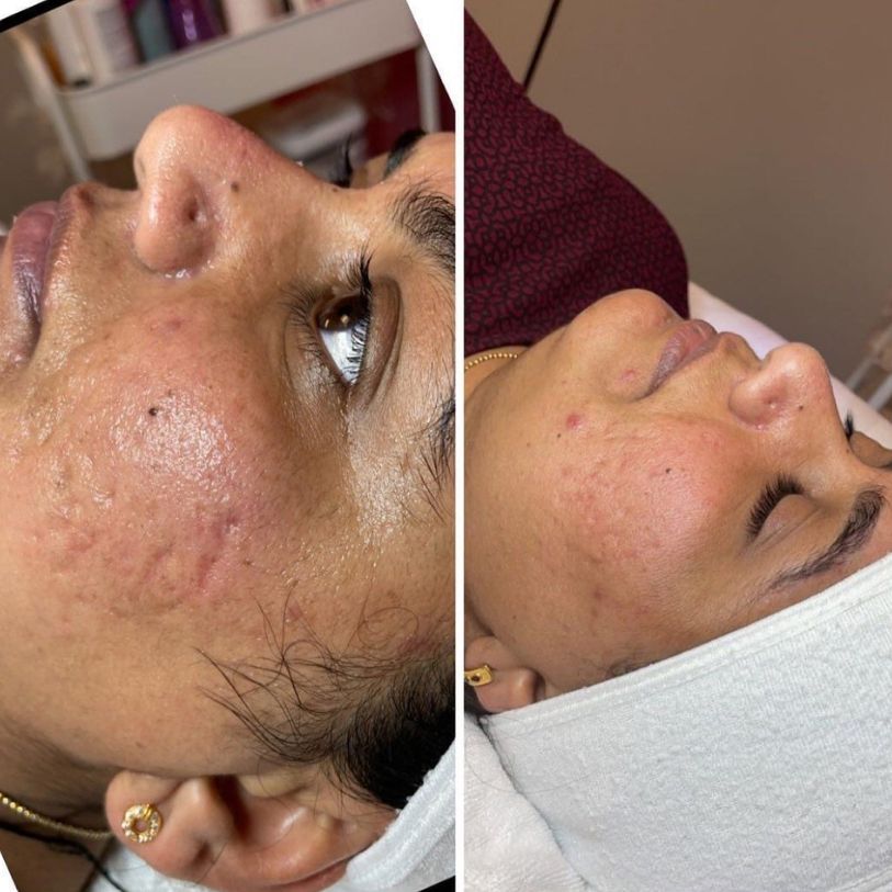 microchanneling-after Microchanneling treatment before and after.