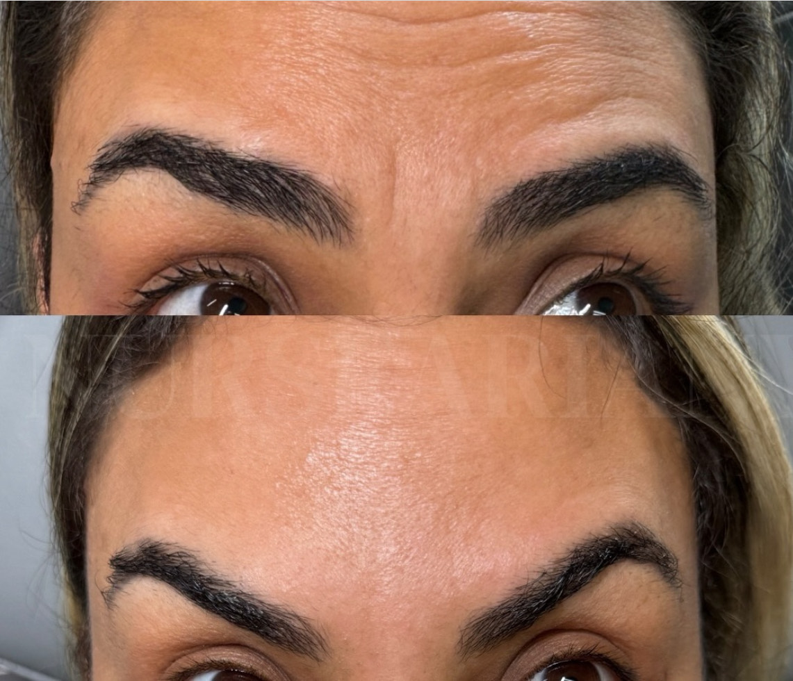 Botox before and after.