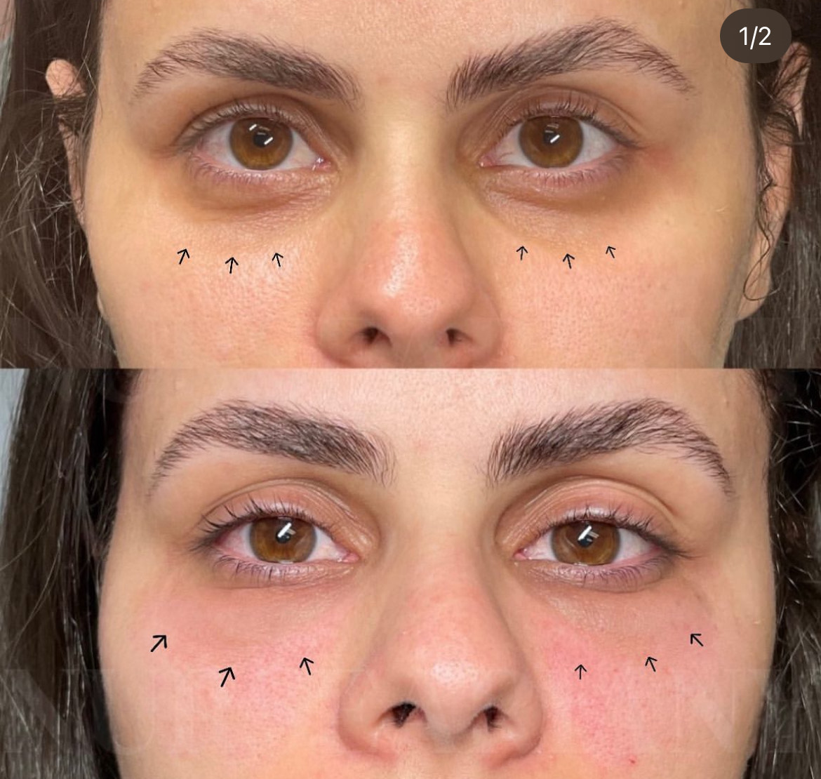 Botox before and after.