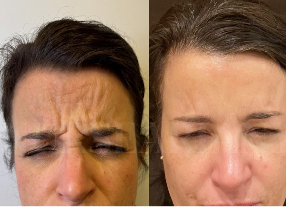 Botox before and after.