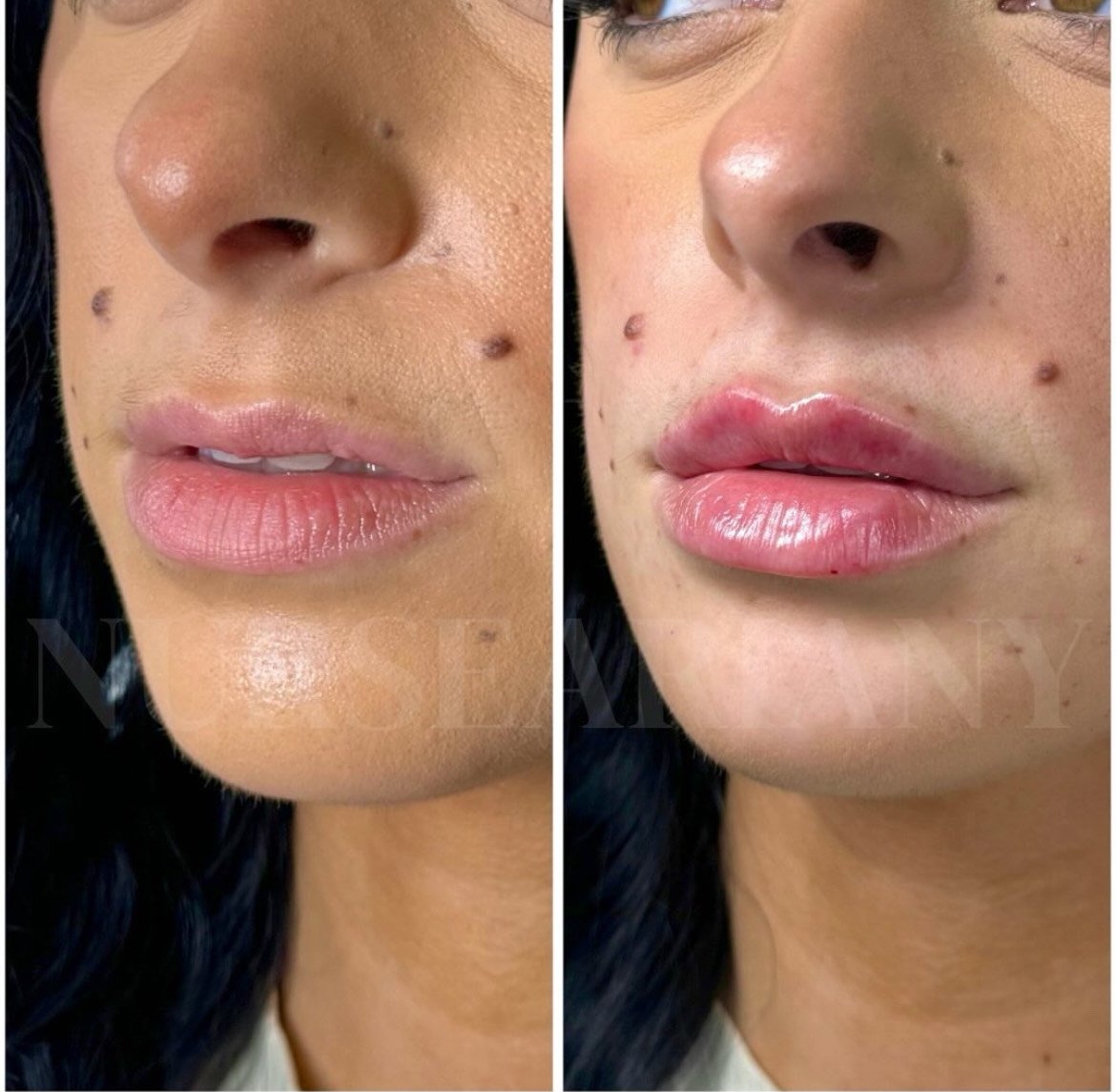 Lip filler treatment before and after.