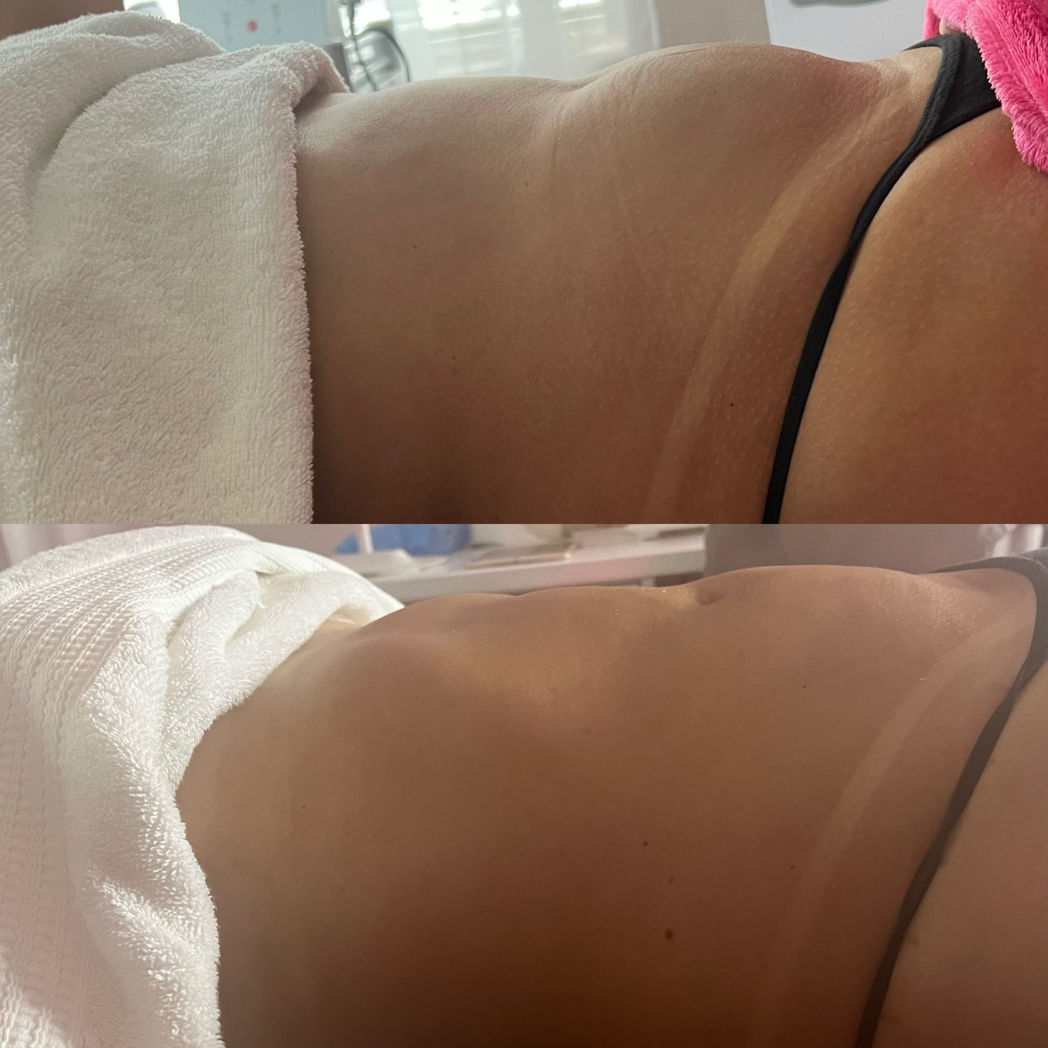 Lymphatic drainage massage before and after.