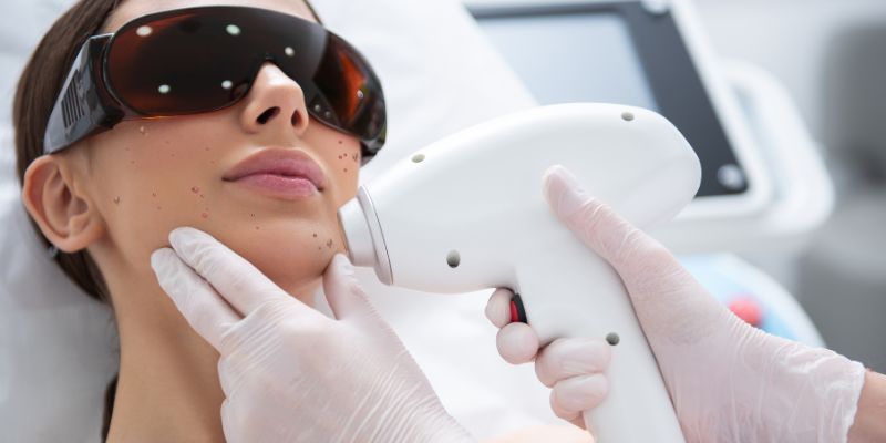 The carbon dioxide (CO2) used in laser treatment for Hidradenitis Suppurativa is a high-energy beam of light that is used to cut, burn, or destroy tissue in the targeted or surrounding areas where the damage has been done. It helps the skin regenerate by aiding healing and causing less inflammation, which improves the skin condition.
